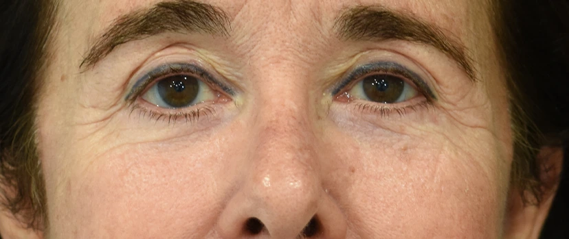 Eyelid Surgery Patient 14 Set 1 After