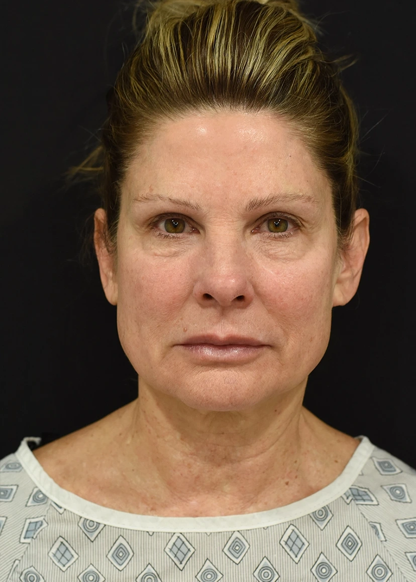 Deep Plane Facelift Patient 16 Set 1 Before