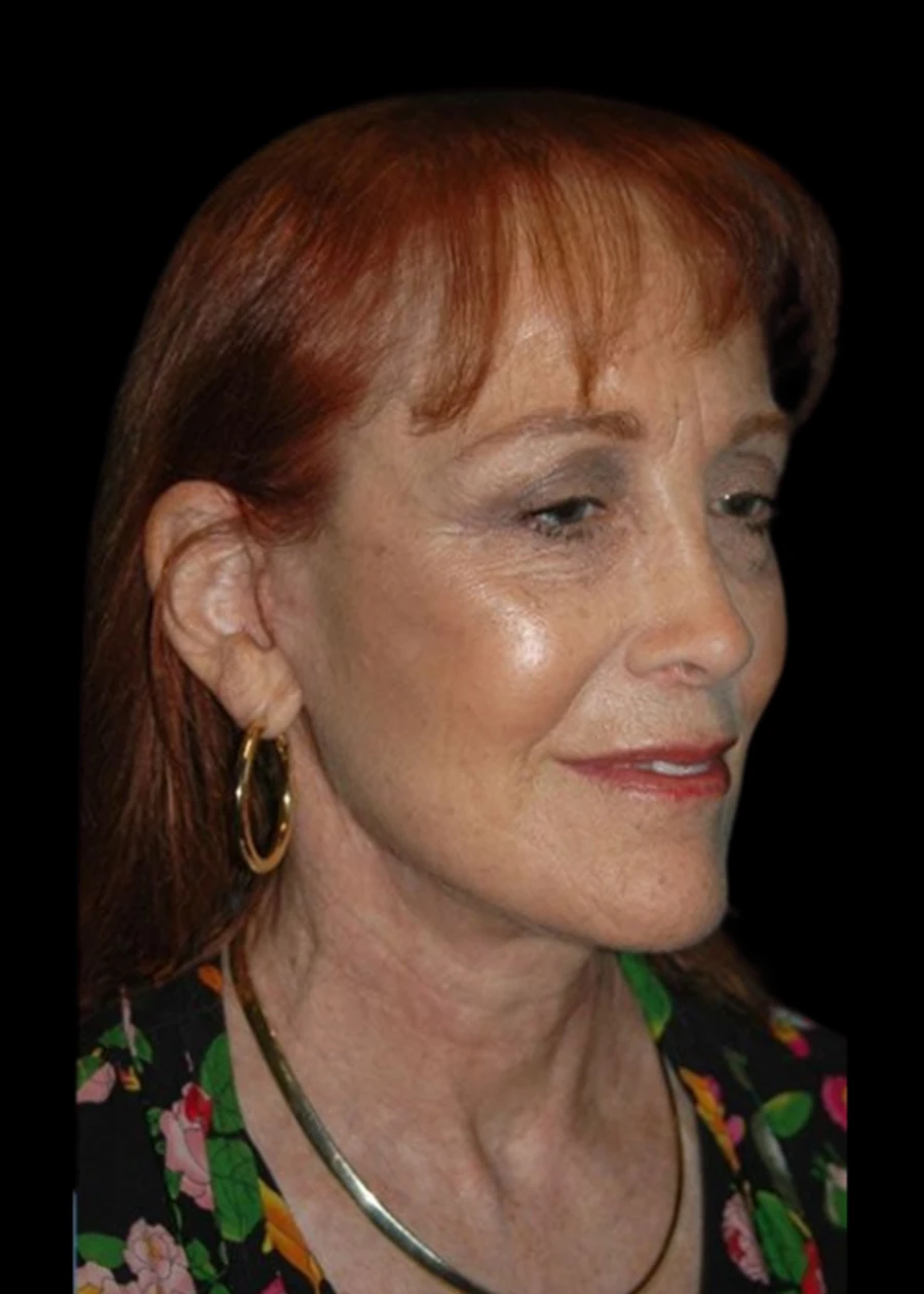 Extended Deep Plane Facelift Patient 7 Set 1 After