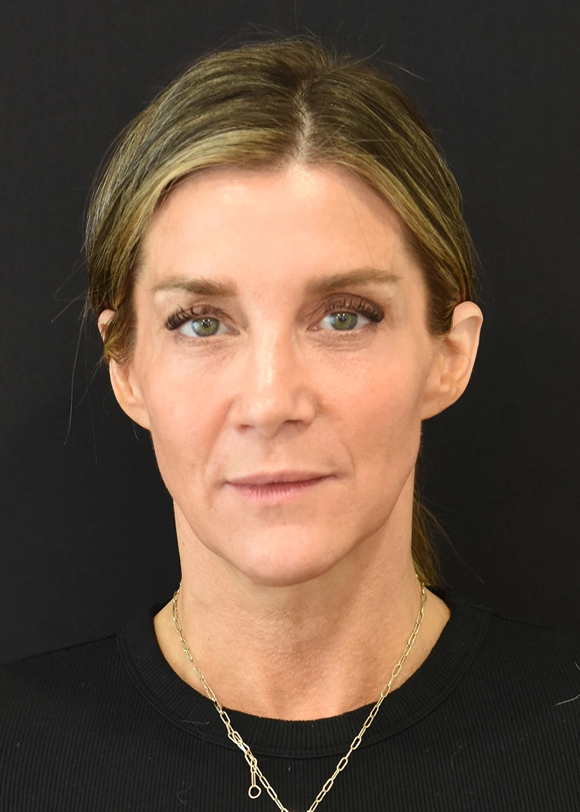 Deep Plane Facelift Patient 25 Set 1 Before