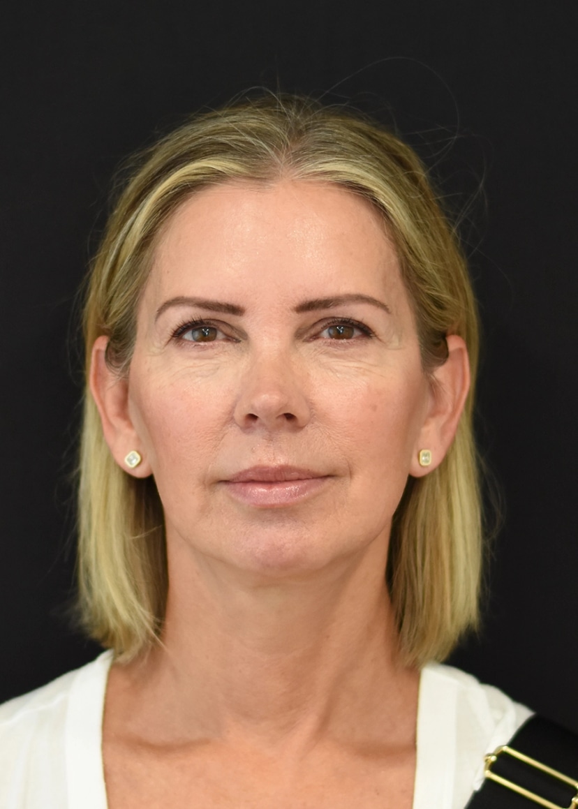 Extended Deep Plane Facelift Patient 1 Set 1 After