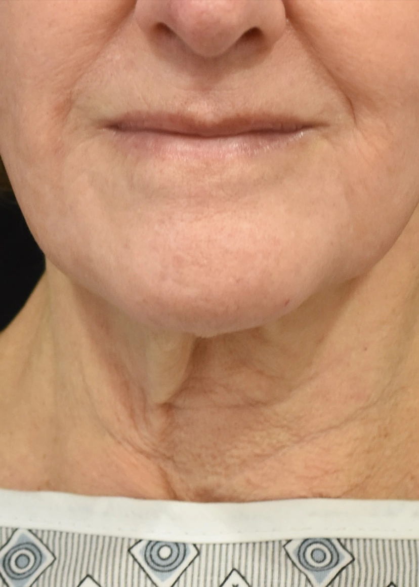 Deep Plane Facelift Patient 33 Set 1 Before