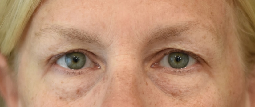 Eyelid Surgery Patient 10 Set 1 Before