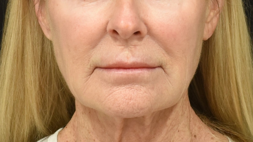 Extended Deep Plane Facelift Patient 14 Set 1 Before