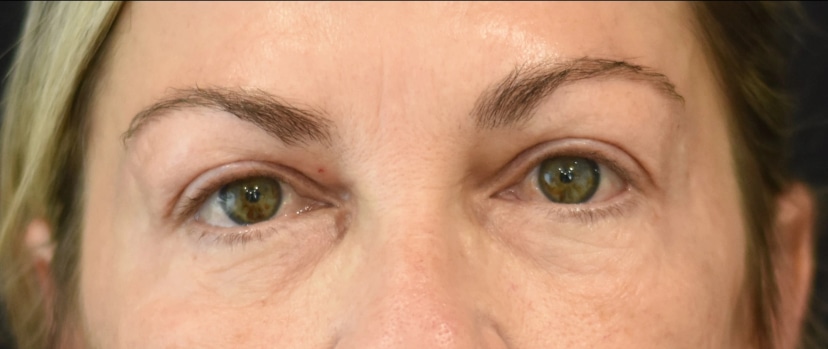 Eyelid Surgery Patient 2 Set 1 After