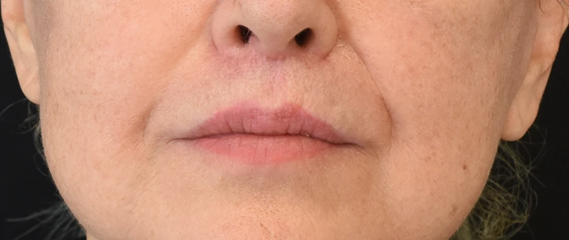 Lip Lift Patient 6 Set 1 After