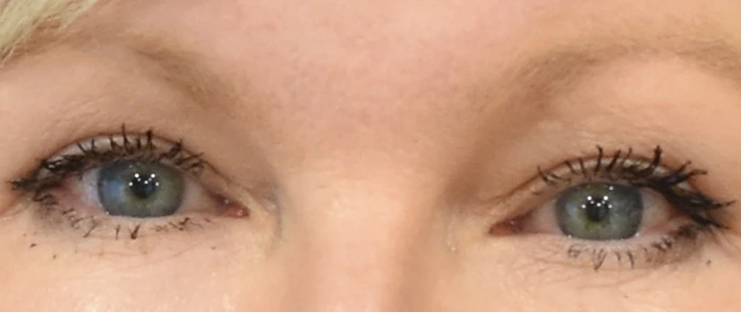Eyelid Surgery Patient 13 Set 1 After