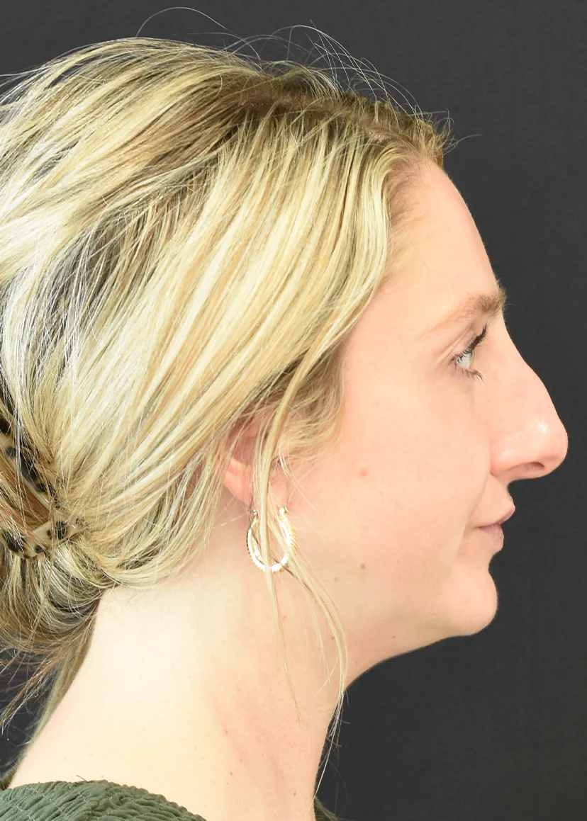 Rhinoplasty Patient 6 Set 3 Before