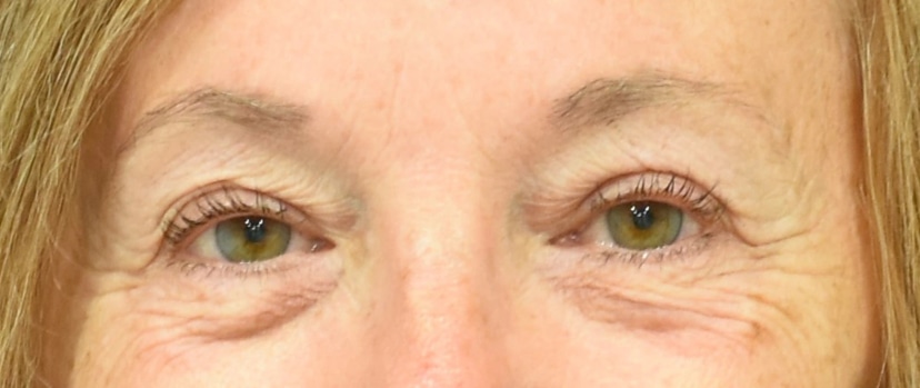 Eyelid Surgery Patient 4 Set 1 After