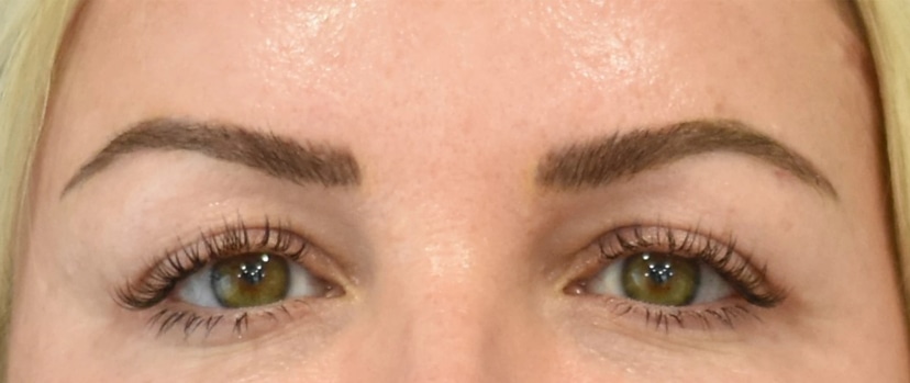 Brow Lift Patient 3 Set 1 After