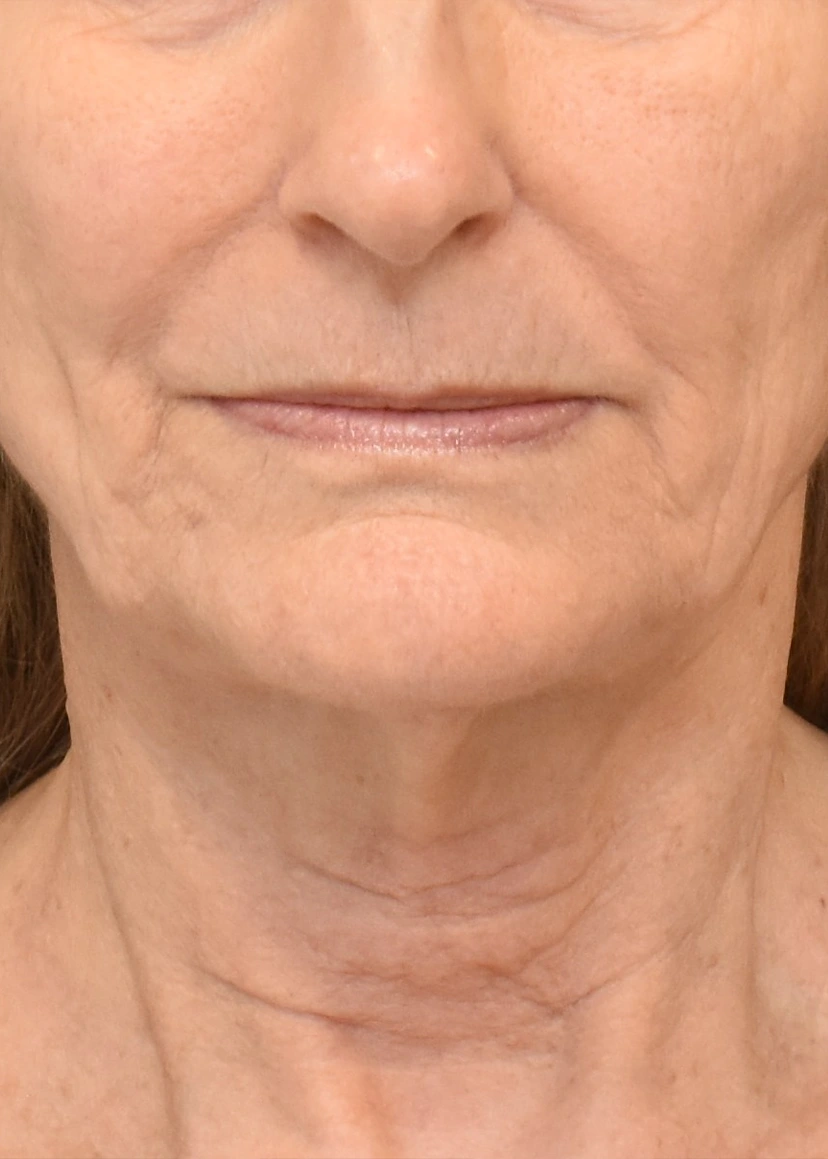Deep Plane Facelift Patient 33 Set 1 Before