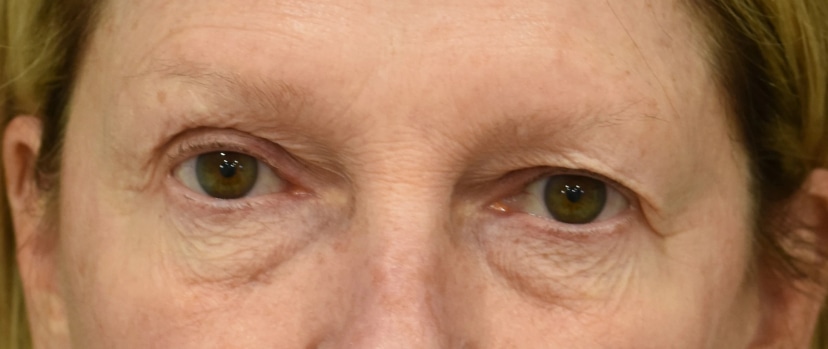 Eyelid Surgery Patient 11 Set 1 Before