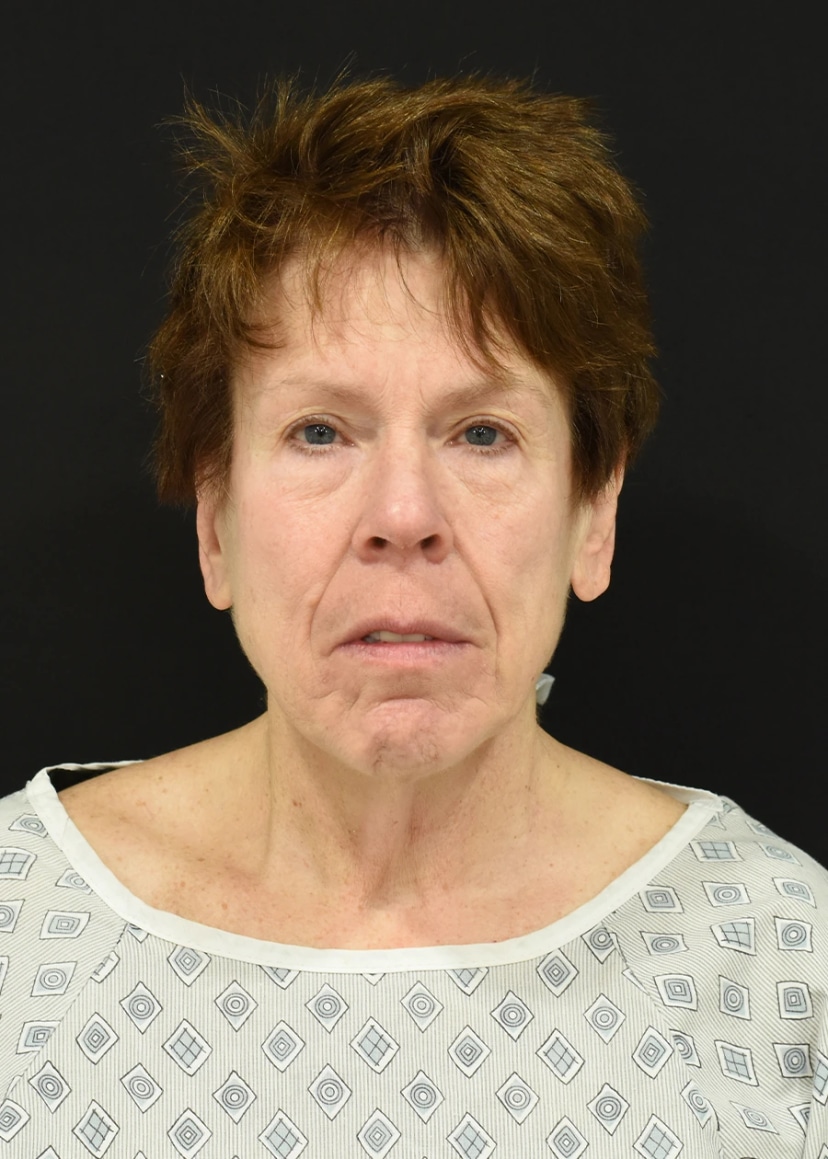 Extended Deep Plane Facelift Patient 13 Set 1 Before