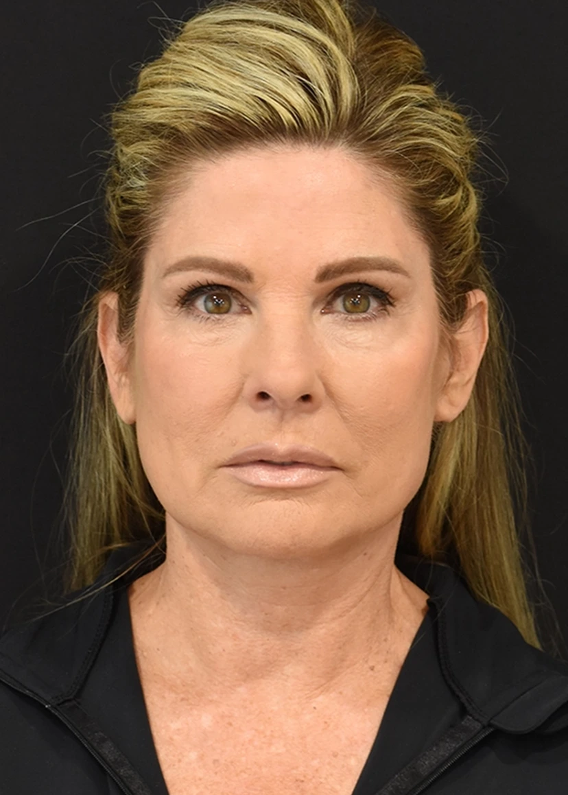 Deep Plane Facelift Patient 16 Set 1 After