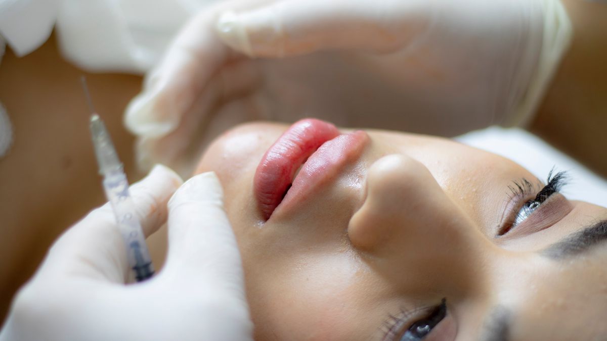 What is Filler Migration?