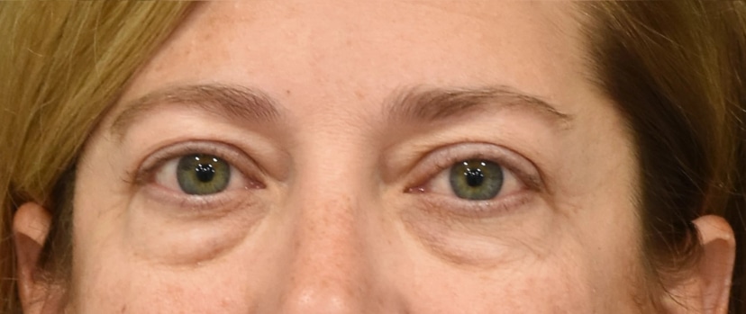 Eyelid Surgery Patient 12 Set 1 Before