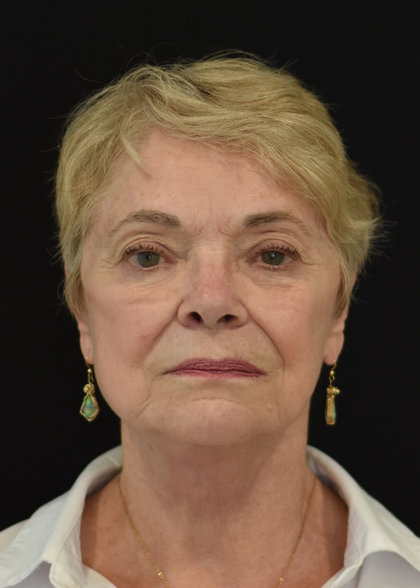 Extended Deep Plane Facelift Patient 10 Set 1 After