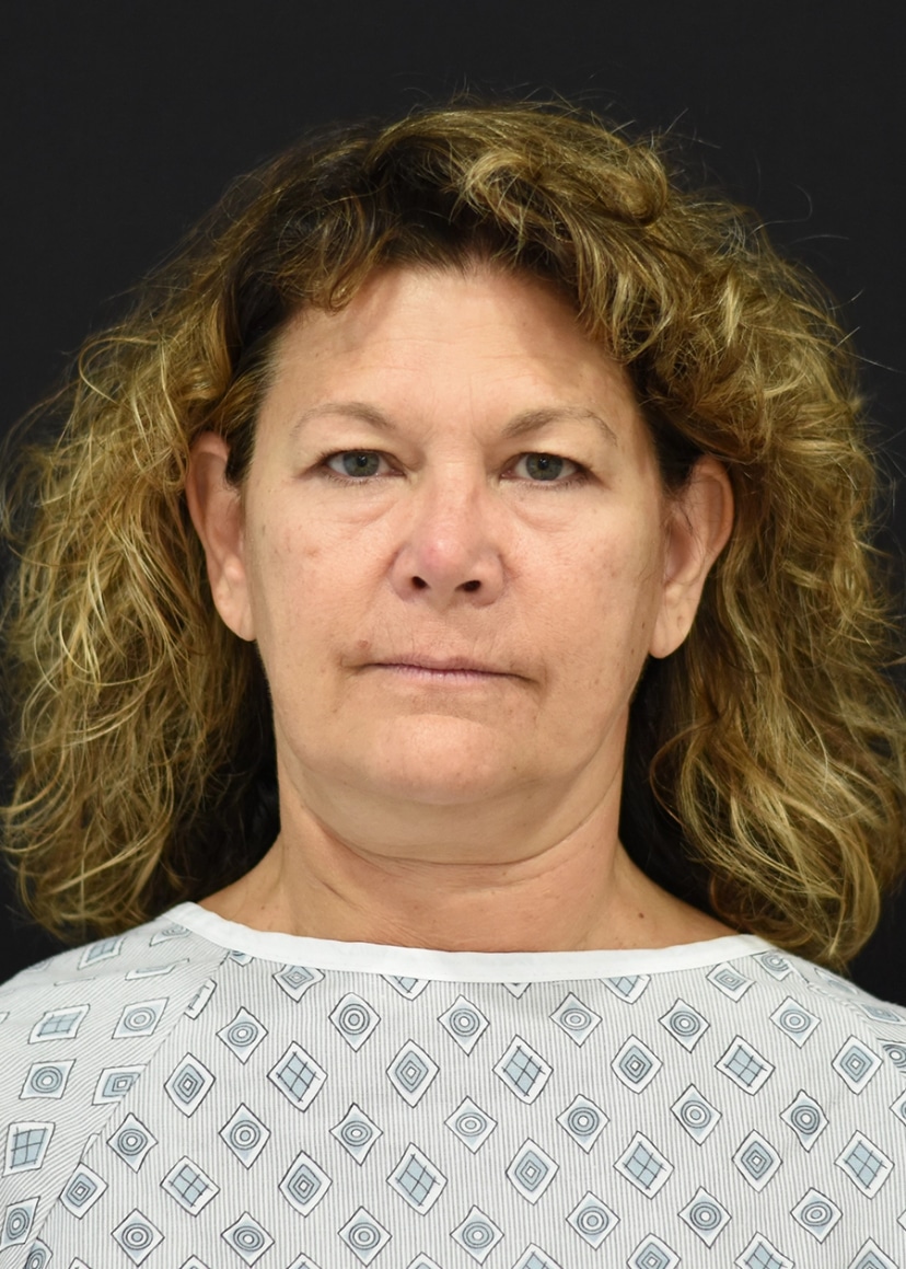 Extended Deep Plane Facelift Patient 4 Set 1 Before