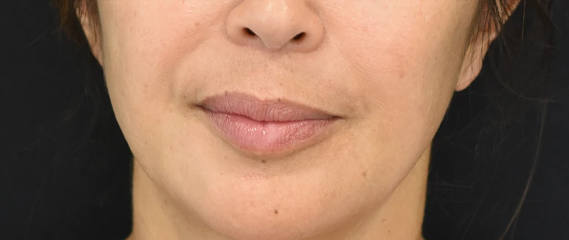 Lip Lift Patient 10 Set 1 Before
