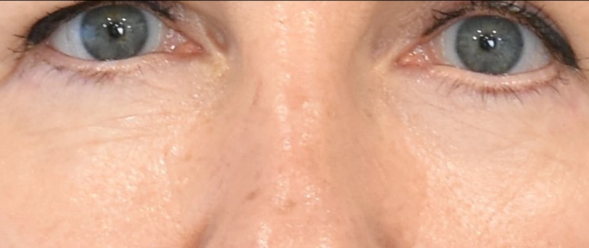 Brow Lift Patient 2 Set 1 After