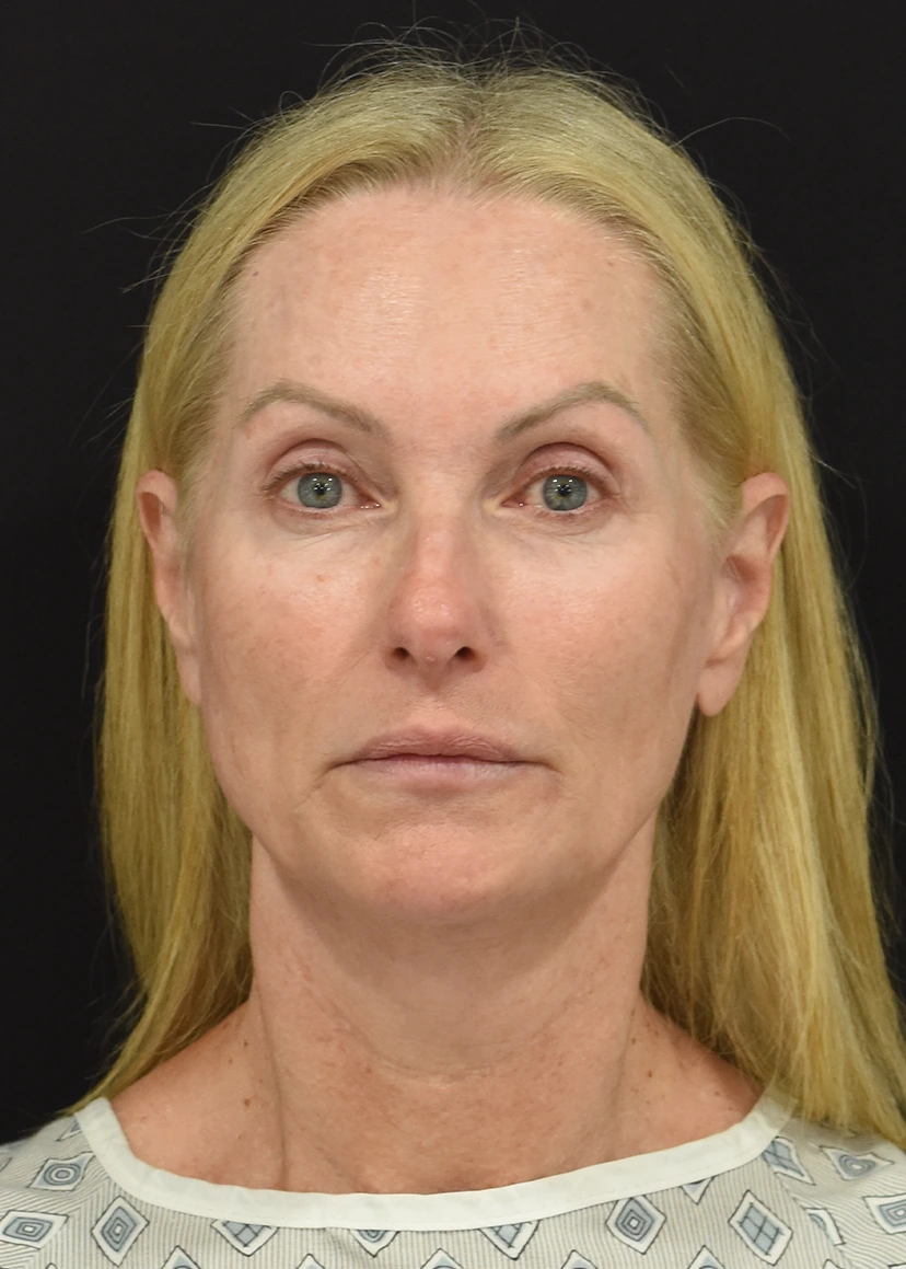 Deep Plane Facelift Patient 27 Set 1 Before