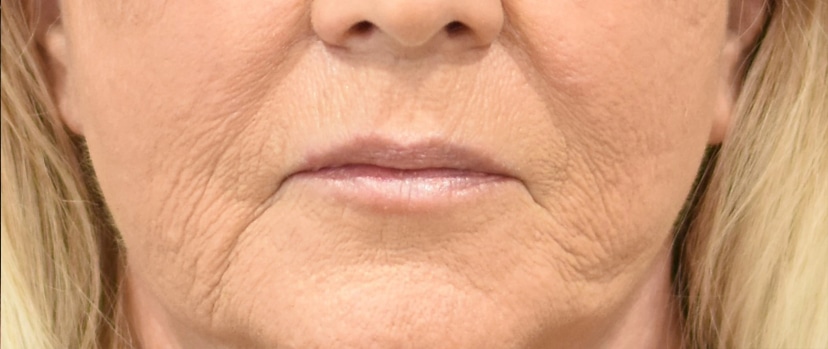 Lip Lift Patient 1 Set 1 After