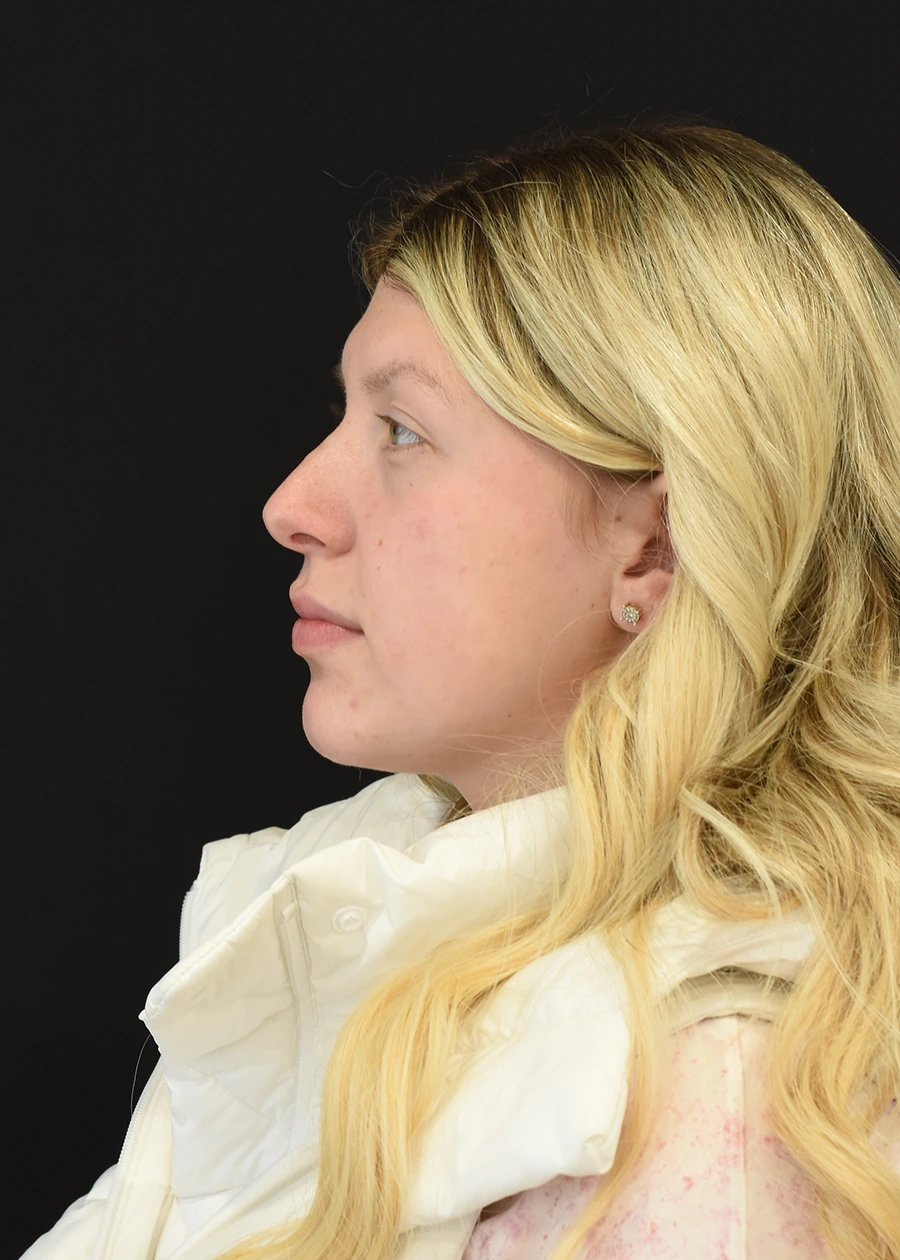 Rhinoplasty Patient 1 Set 2 After