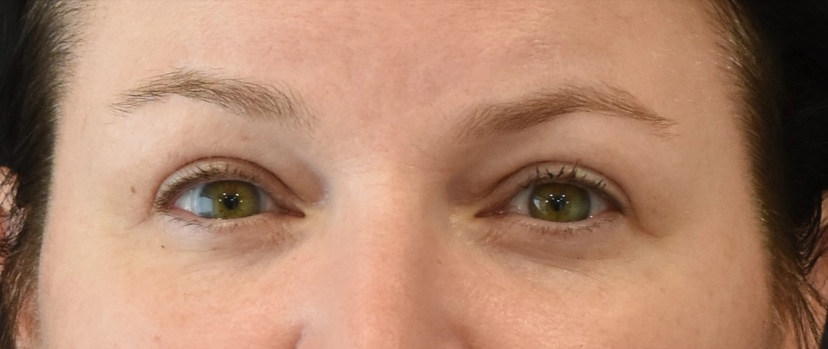 Eyelid Surgery Patient 9 Set 1 After