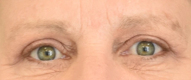 Brow Lift Patient 14 Set 1 After