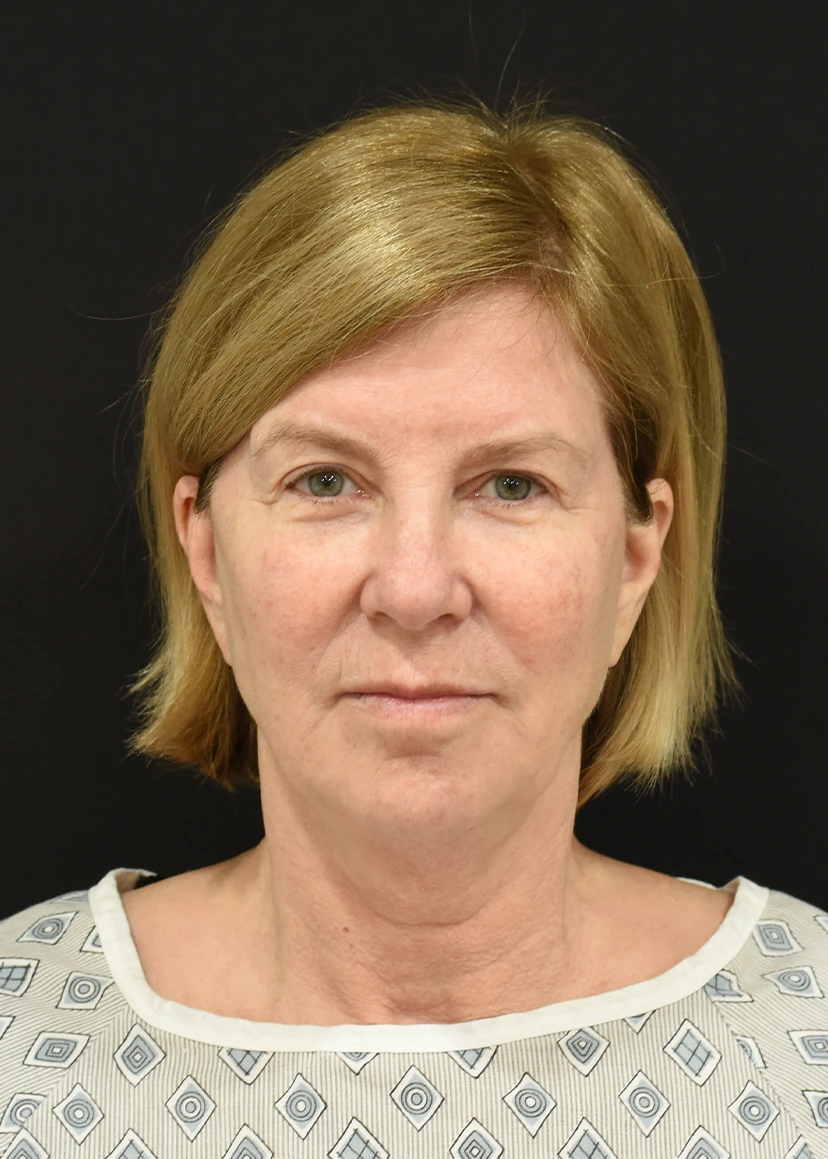 Deep Plane Facelift Patient 28 Set 1 Before