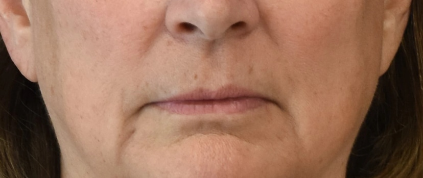 Lip Lift Patient 3 Set 1 Before