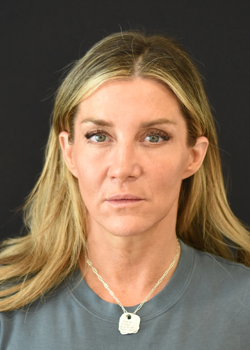 Deep Plane Facelift Patient 25 Set 1 After