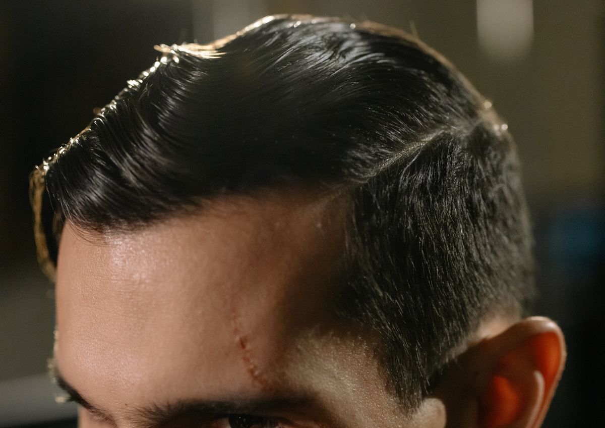 Scar Treatment: An Explainer