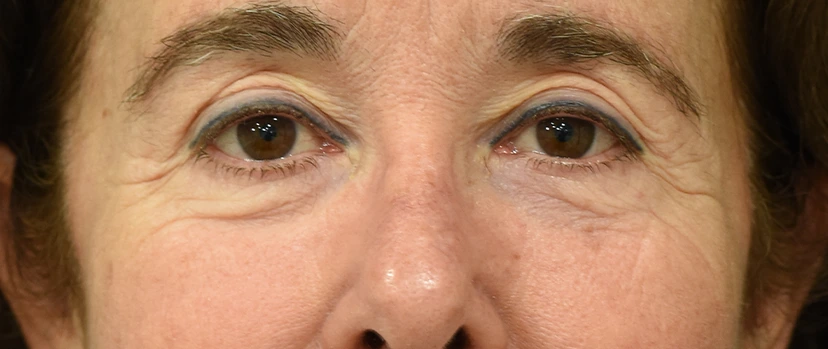 Eyelid Surgery Patient 14 Set 1 Before
